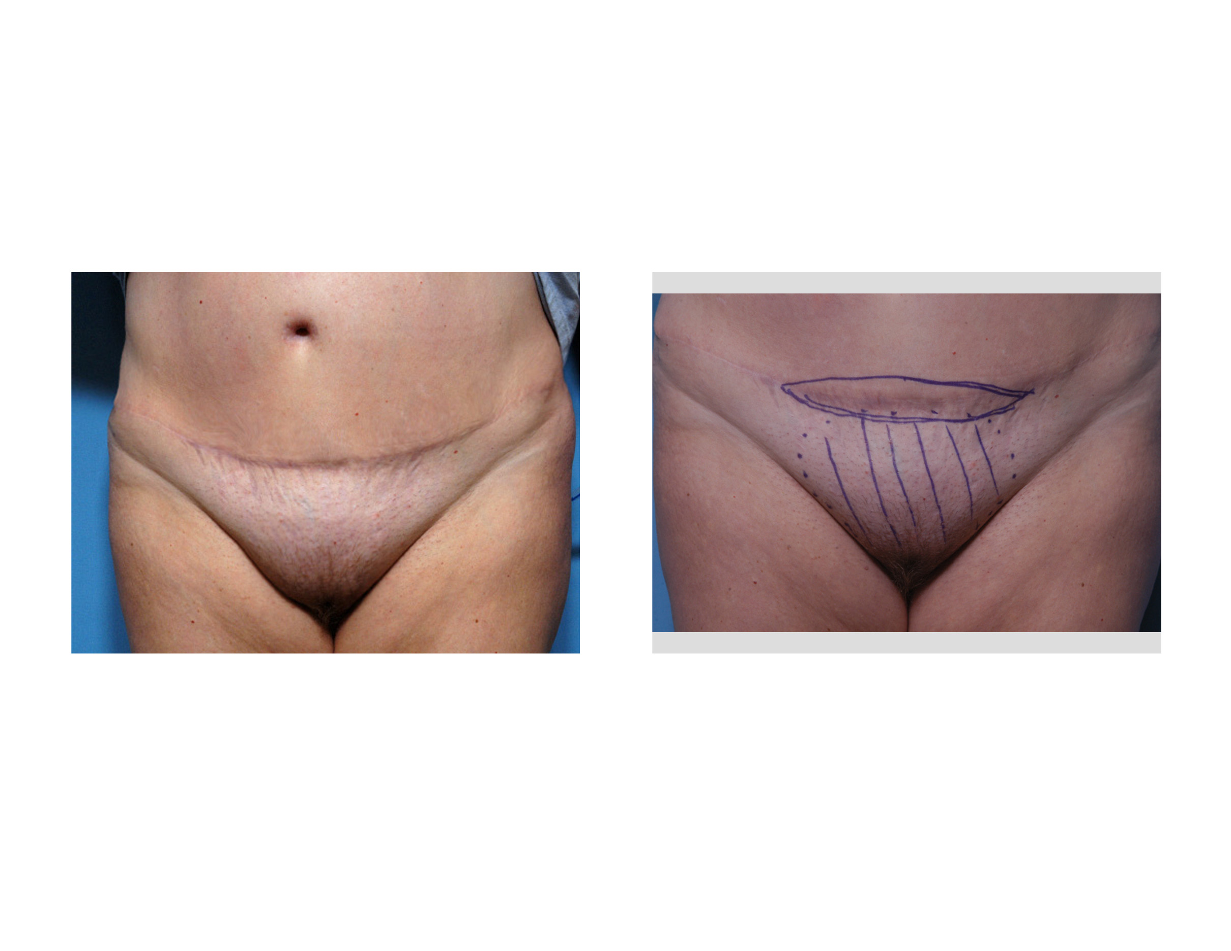 Case Study: Tummy Tuck Surgery and the Potential Need for Revision
