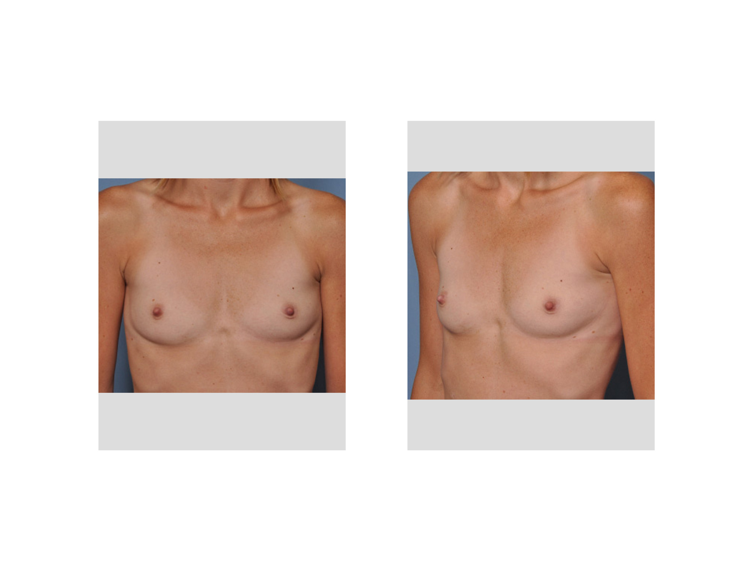 Case Study: Saline Breast Augmentation in Thin Women - Explore
