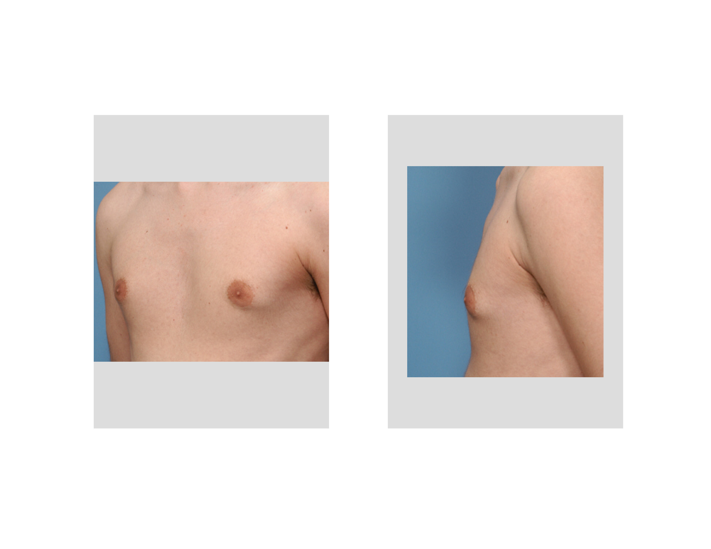 https://exploreplasticsurgery.com/wp-content/uploads/2010/07/puffy-nipples-areolar-gynecomastia-dr-barry-eppley-indianapolis.jpg