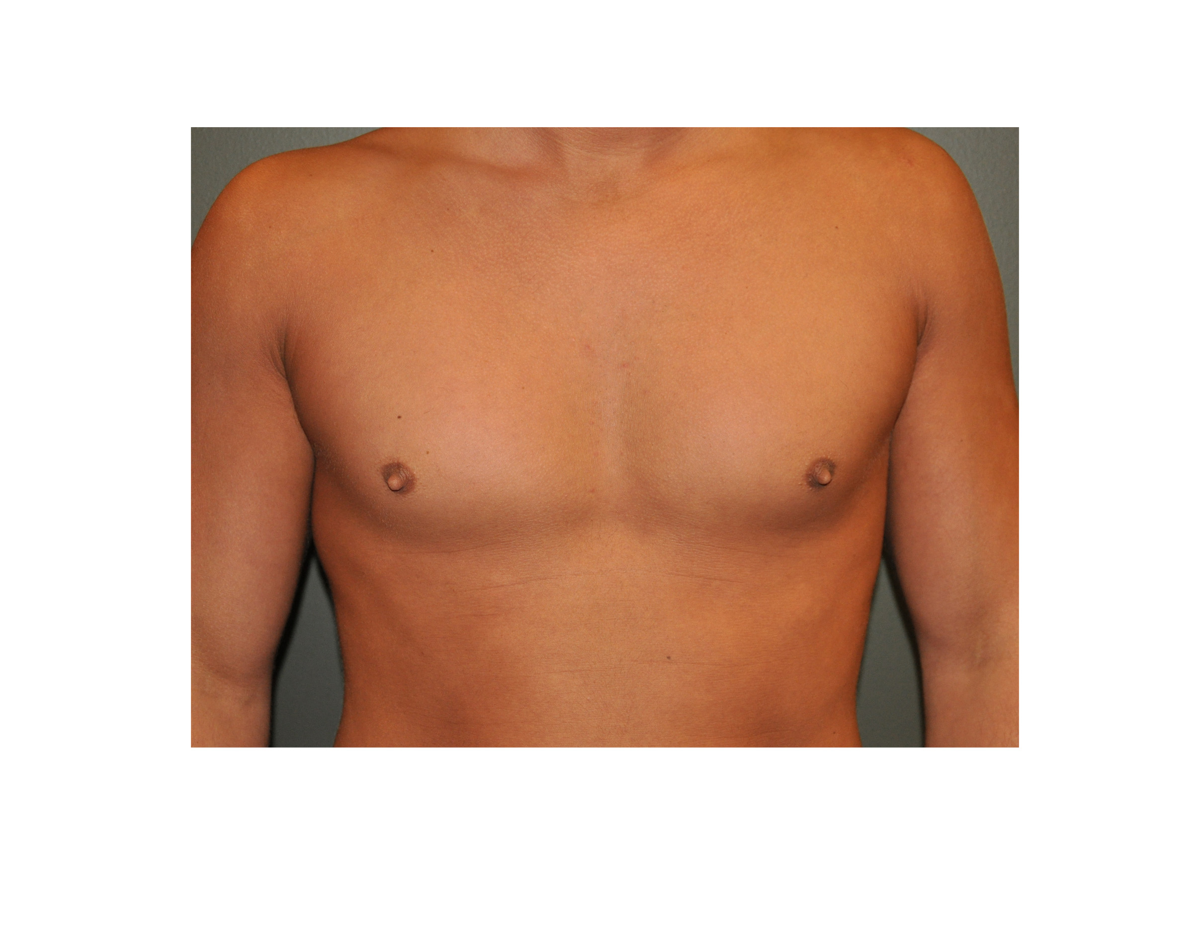 Case Study: Reduction of the Prominent Nipples in Men - Explore