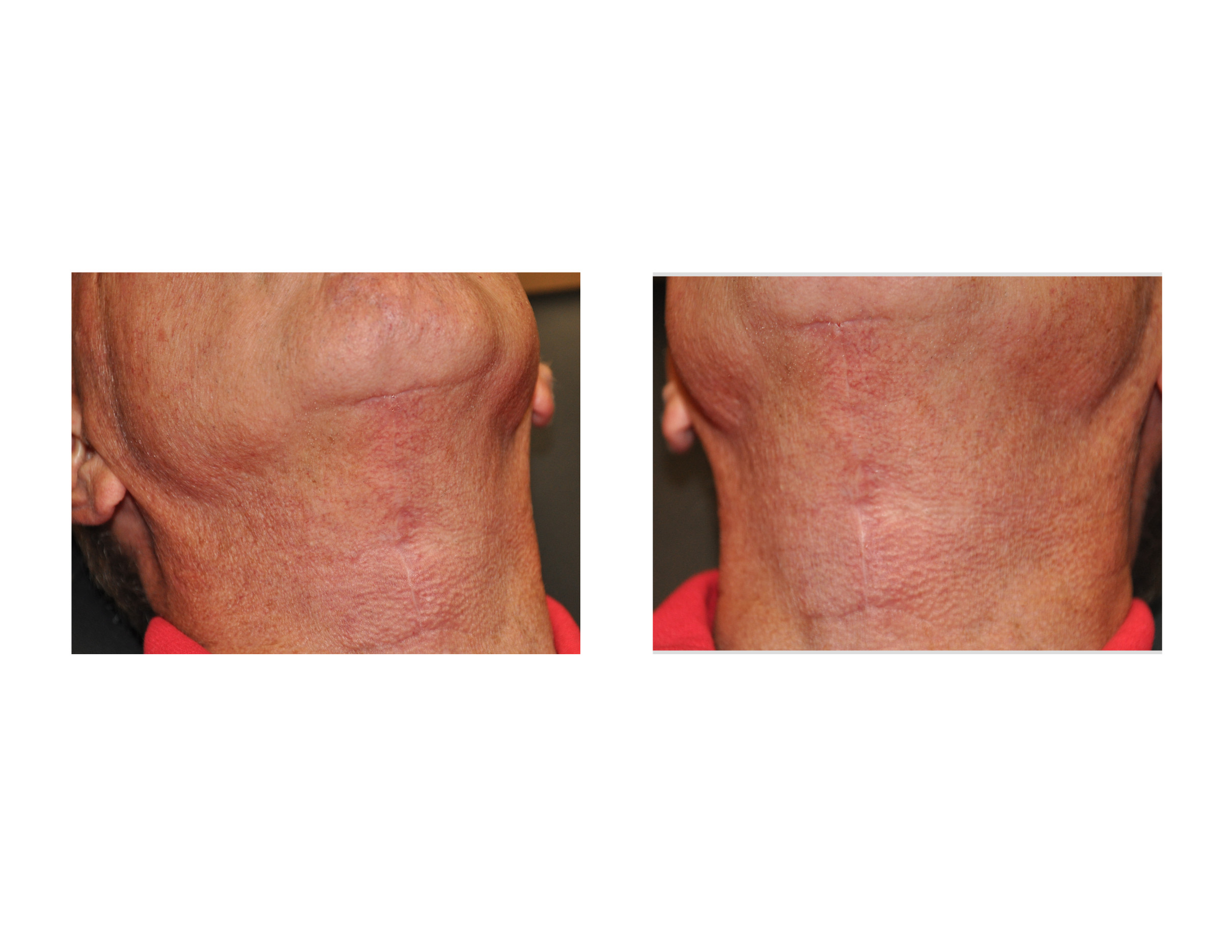 Direct Necklift Scars In Older Men Dr Barry Eppley Indianapolis Explore Plastic Surgery