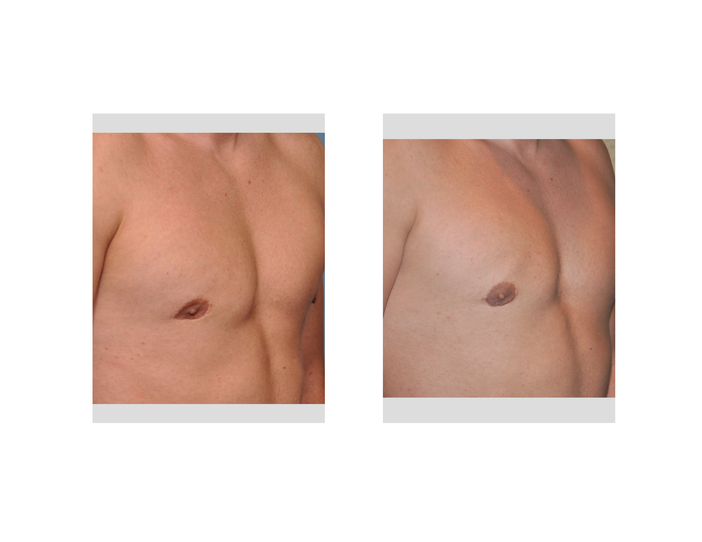 rightchestimplantremovalanddermalfatgrafting Explore Plastic