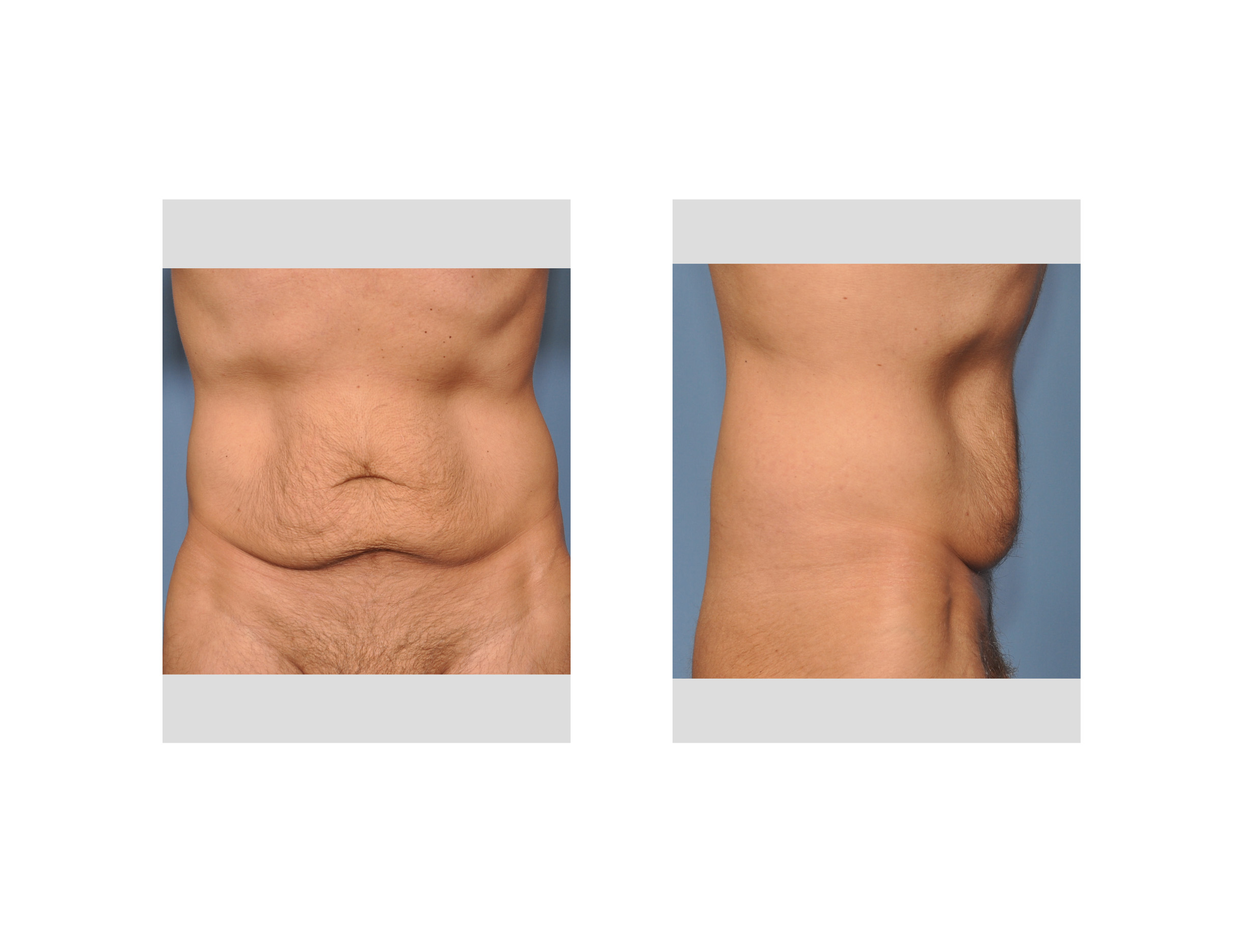 The Male Tummy Tuck after Massive Weight Loss - Explore Plastic Surgery