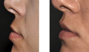 A Modified Subnasal Lip Lift for Columellar Retraction - Explore ...