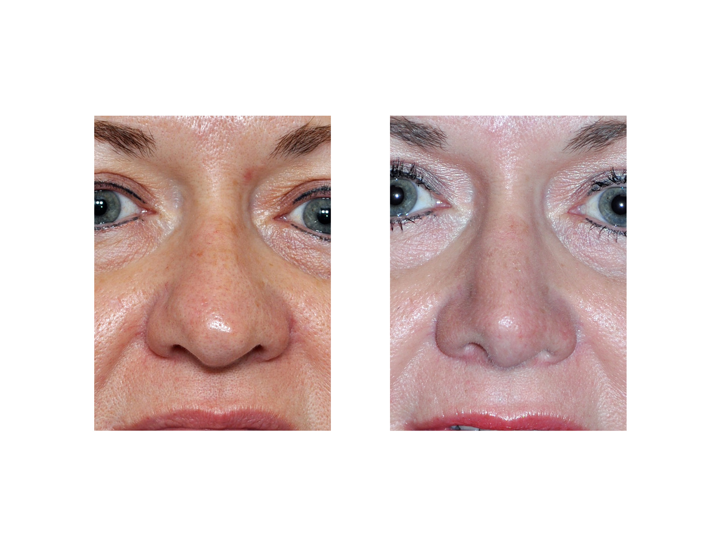 blog-archivecase-study-rhinoplasty-for-the-fat-nose