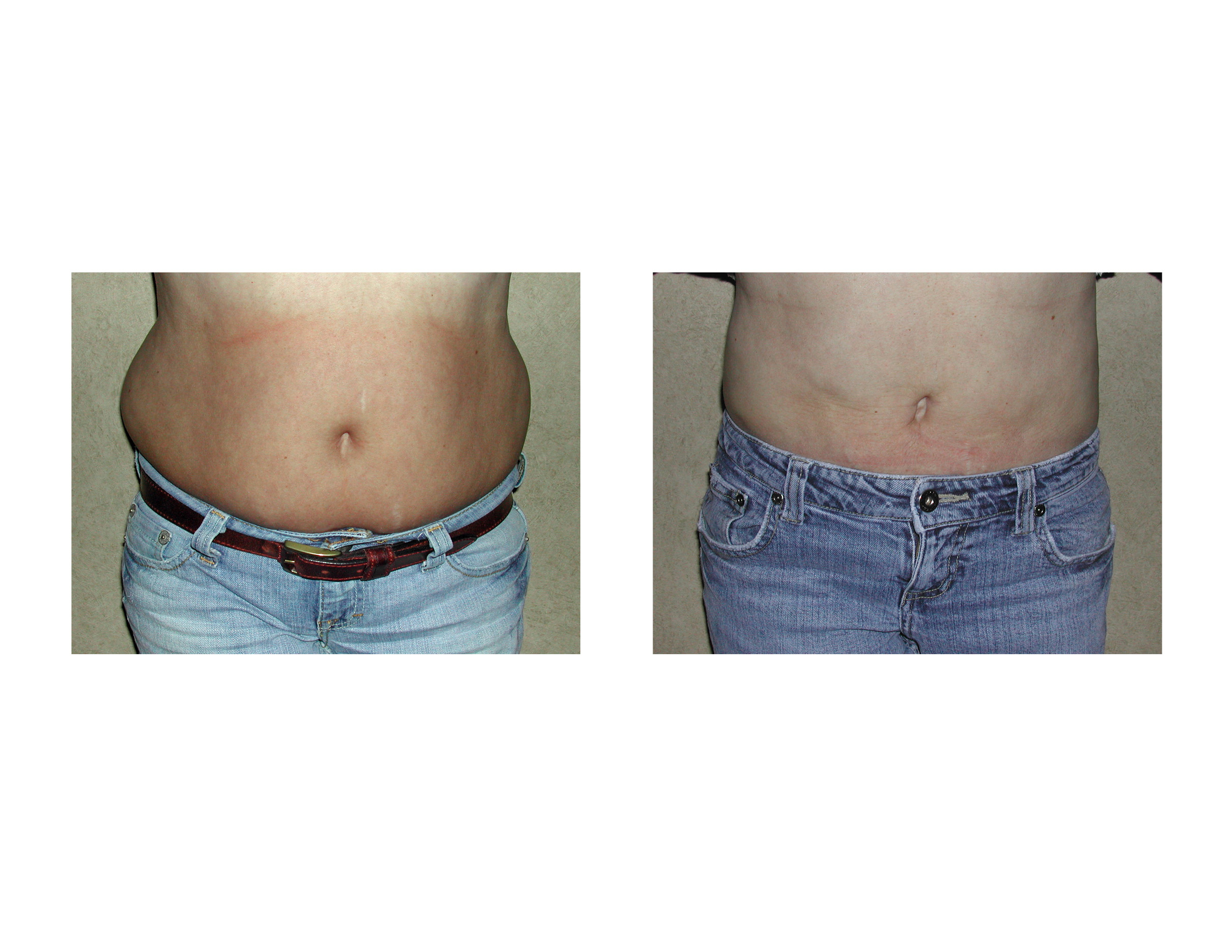 https://exploreplasticsurgery.com/wp-content/uploads/2010/12/liposuction-for-muffin-tops-dr-barry-eppley-indianapolis.jpg
