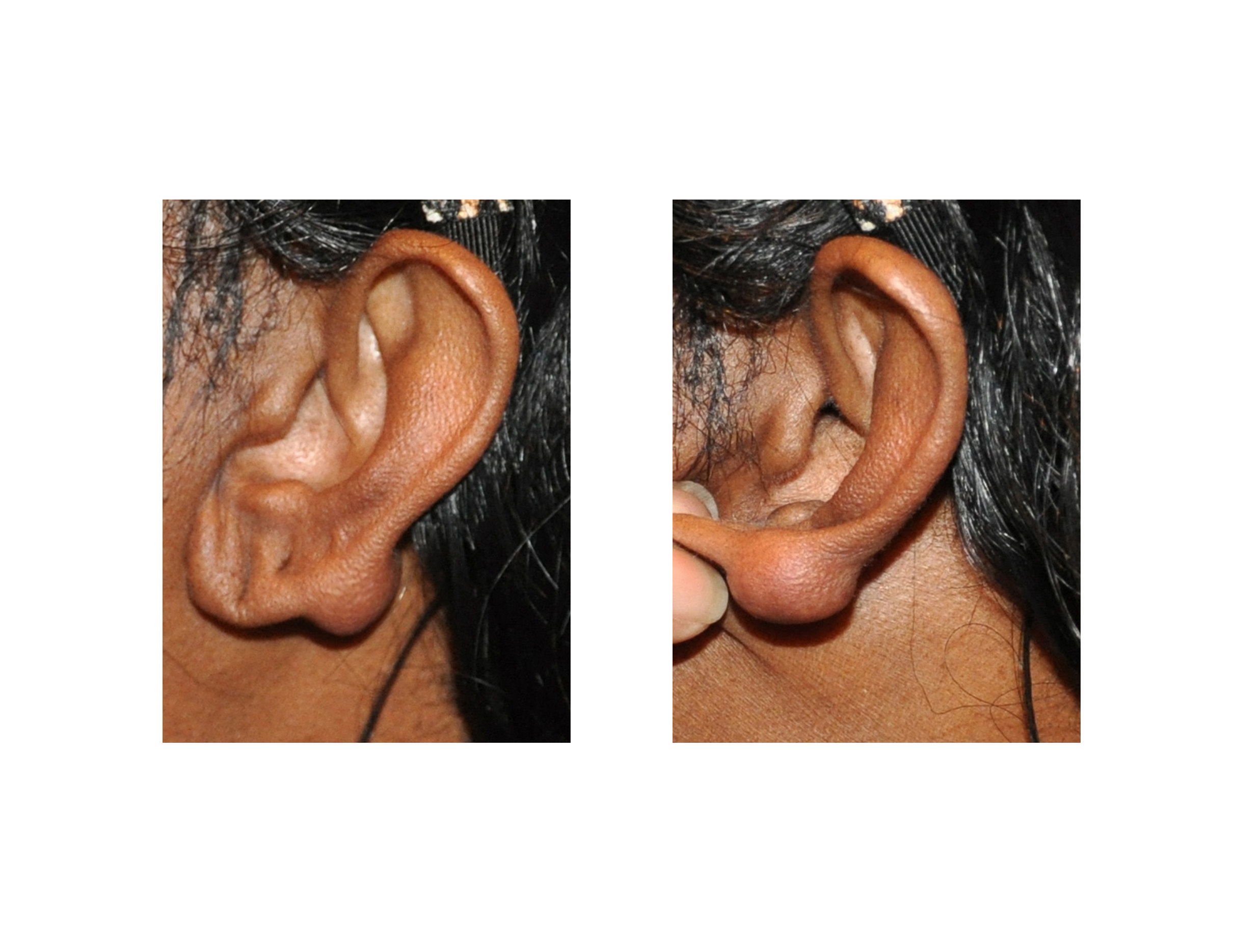 Keloid on Ear: Piercings, Other Causes, Treatment, Removal, Preve