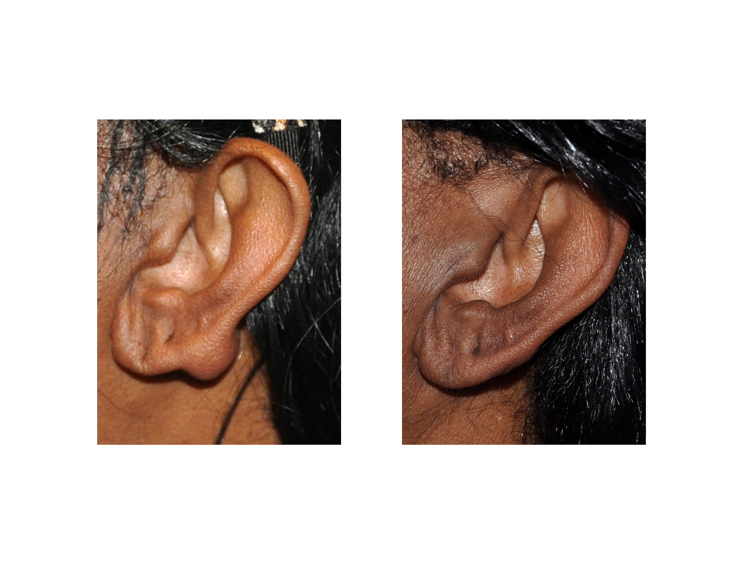 Silver keloid pressure earring  Magnetic earrings for keloids jewelry   Hand Stamped Trinkets