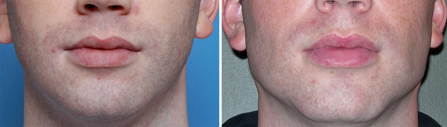 Square Chin Implant Result Front View Dr Barry Eppley Indianapolis 