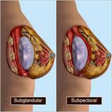Pity, Saline breast implants indiana something How that Saline breast implants indiana share