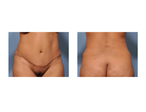 Case Study: Secondary Liposuction After Tummy Tuck Surgery - Explore  Plastic Surgery