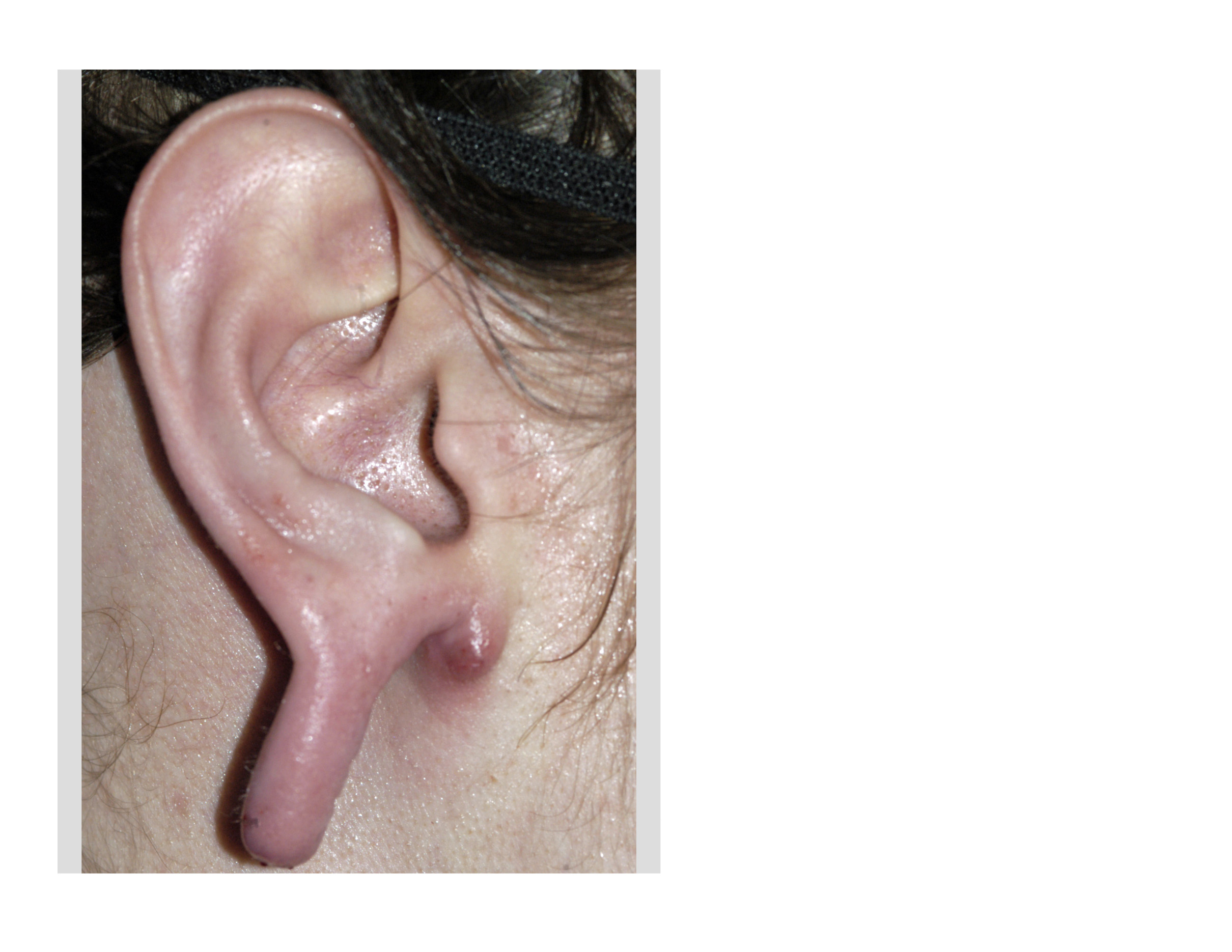 Torn and stretched ear lobe repairs - Kingsley Medical