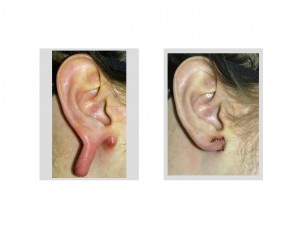 Poughkeepsie Earlobe Repair Poughkeepsie Gauge Earring Surgeon