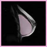 mri-breast-implant-dr-barry-eppley-indianapolis - Explore Plastic Surgery