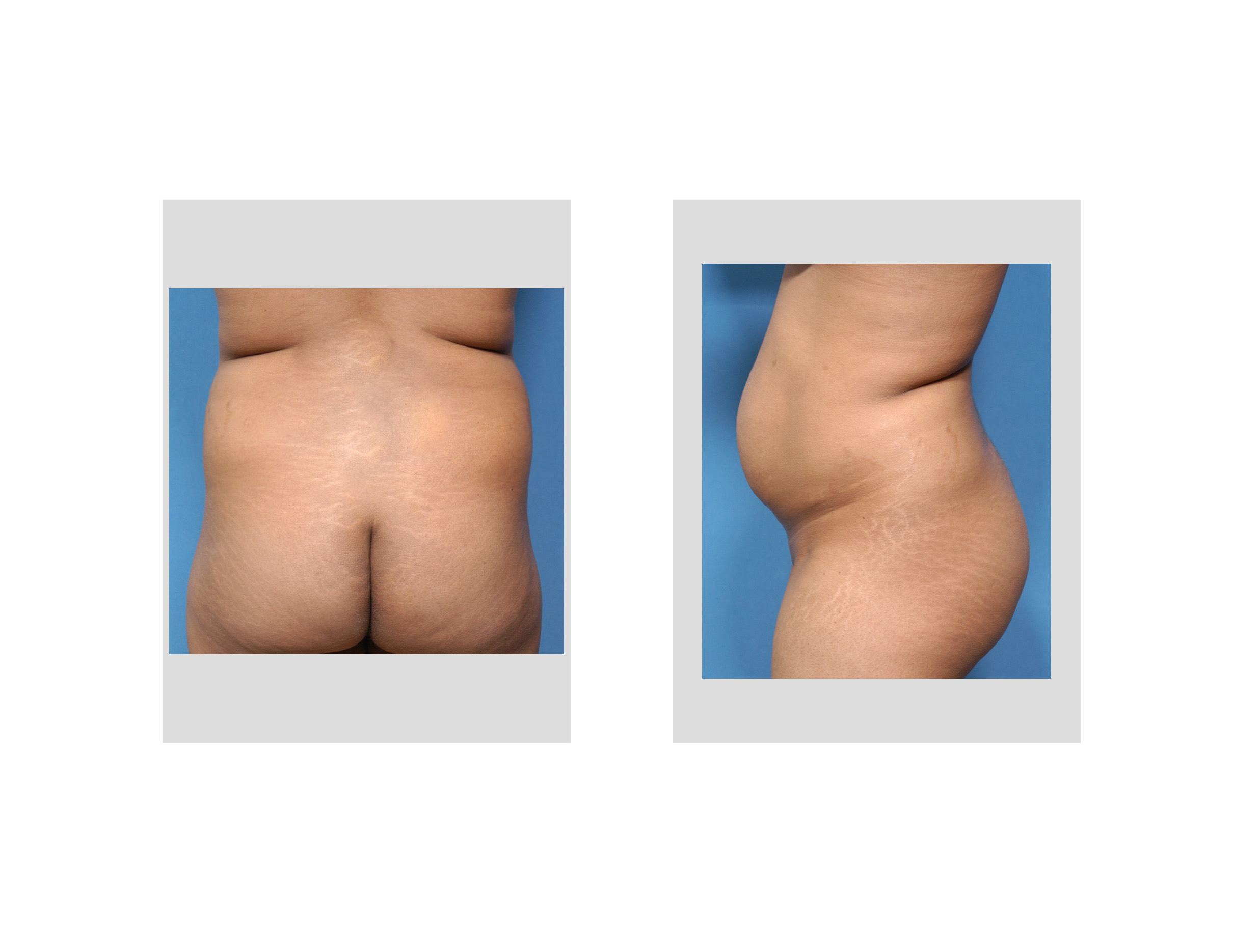 Waistline Reshaping With Muffin Top Liposuction - Explore Plastic Surgery