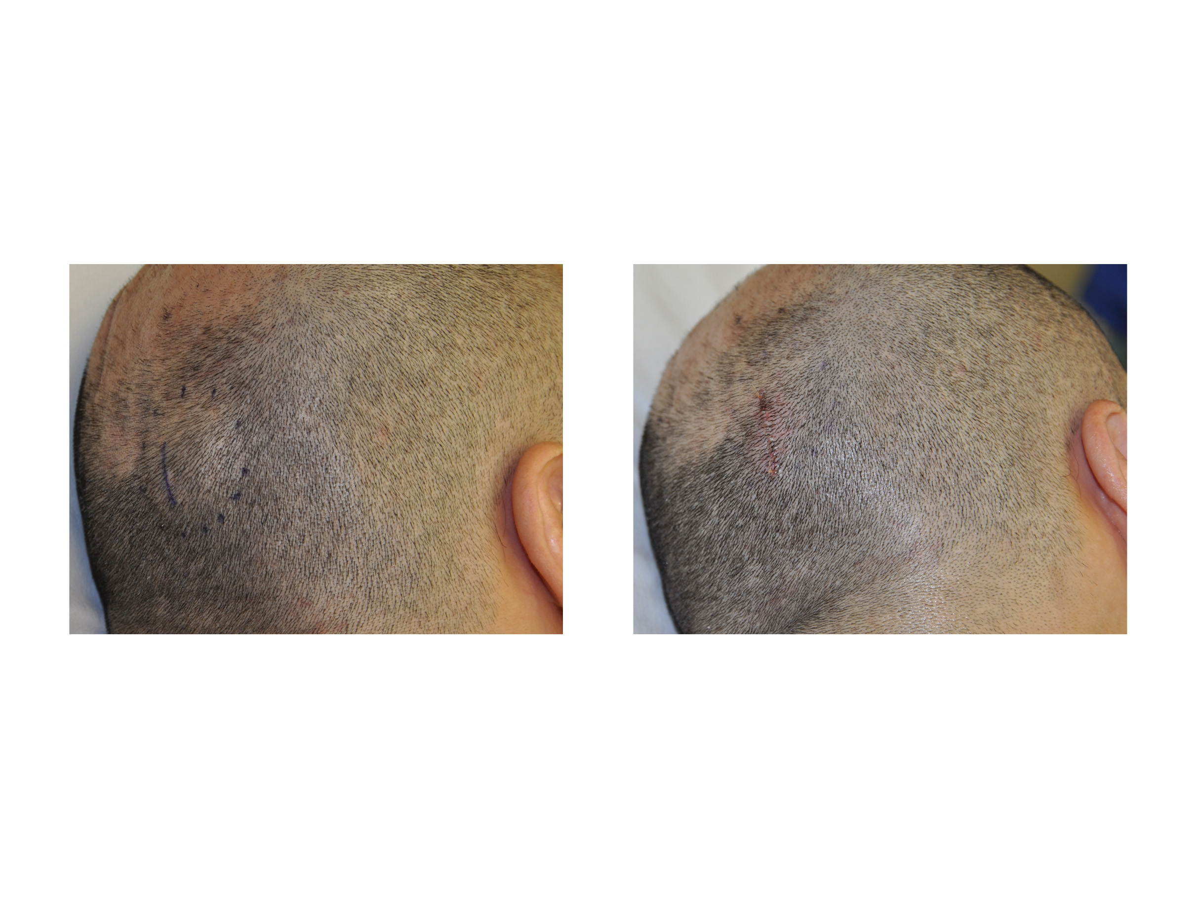 Case Study Removal Of Skull Lumps And Bumps Osteomas Explore Plastic Surgery