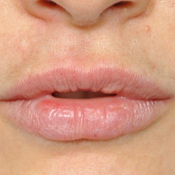 The Unique Skin of the Eyelids and Lips - Explore Plastic Surgery