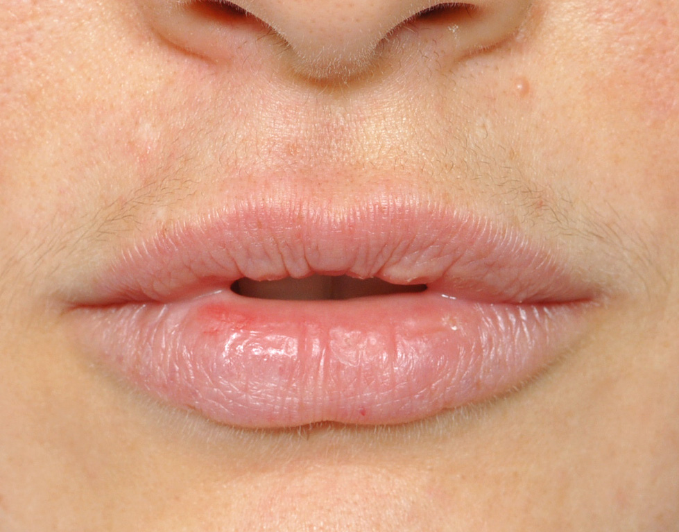 The Unique Skin of the Lips Dr Barry Eppley Indianapolis - Explore ...