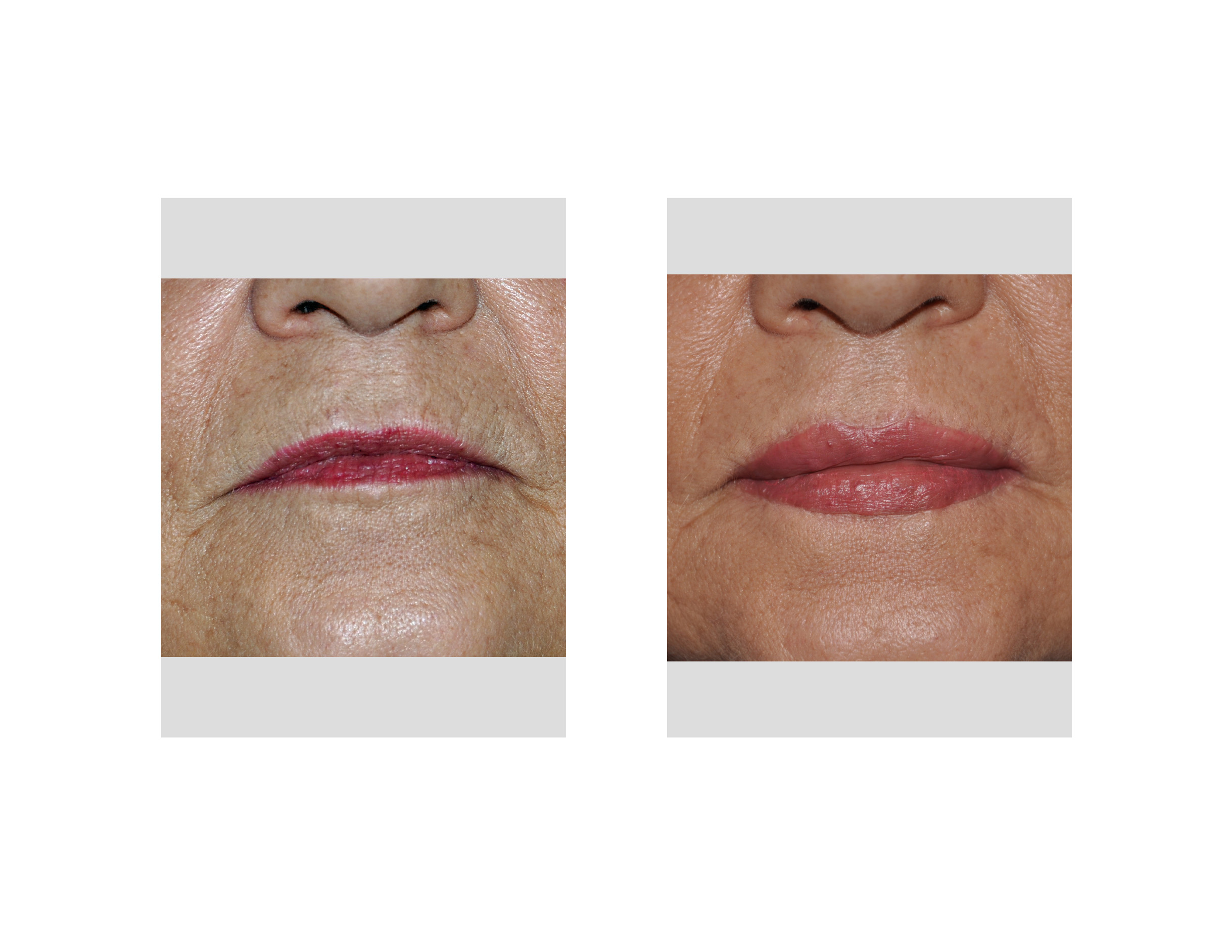 Lip Advancement Results Front View Dr Barry Eppley Indianapolis Explore Plastic Surgery 0399