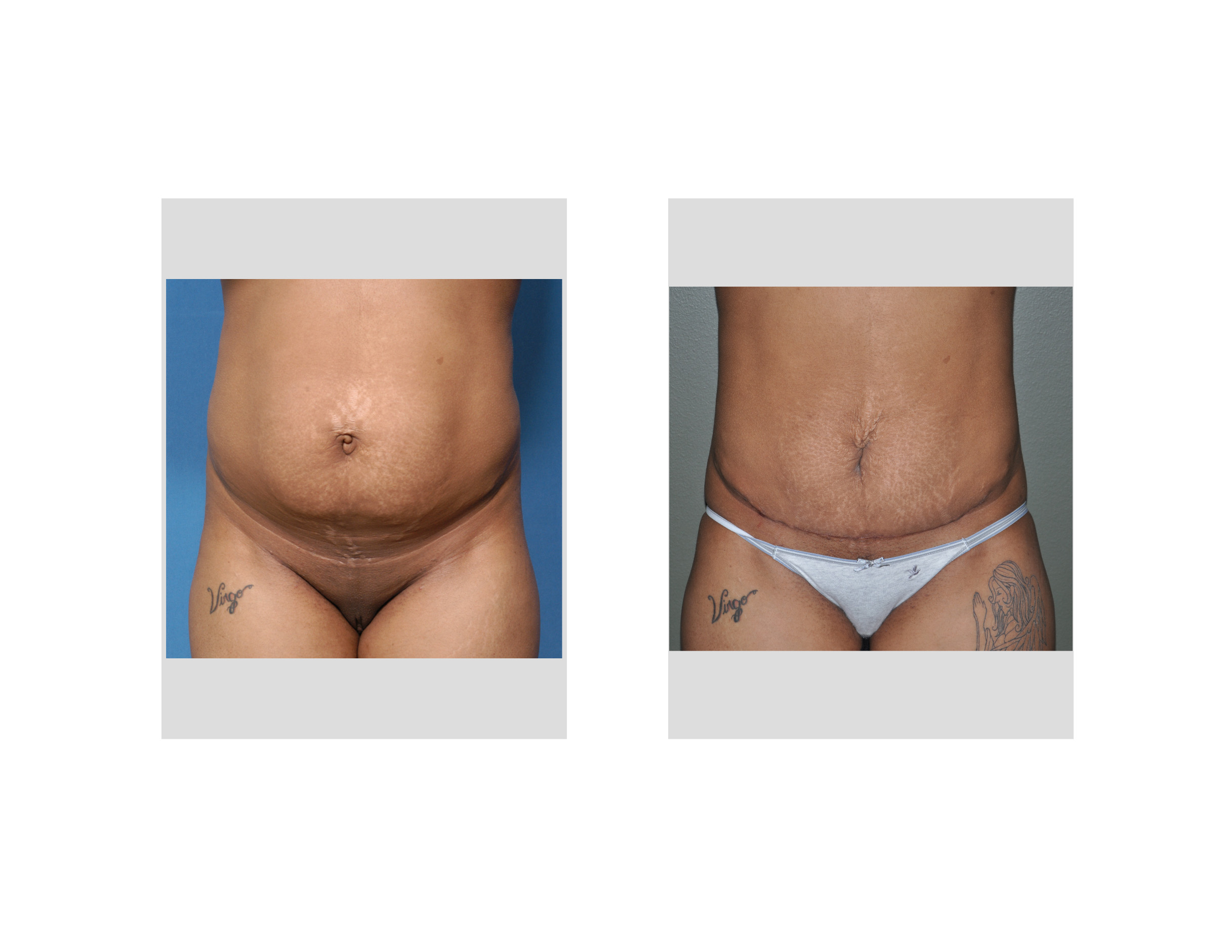 What Helps Tightness After a Tummy Tuck?