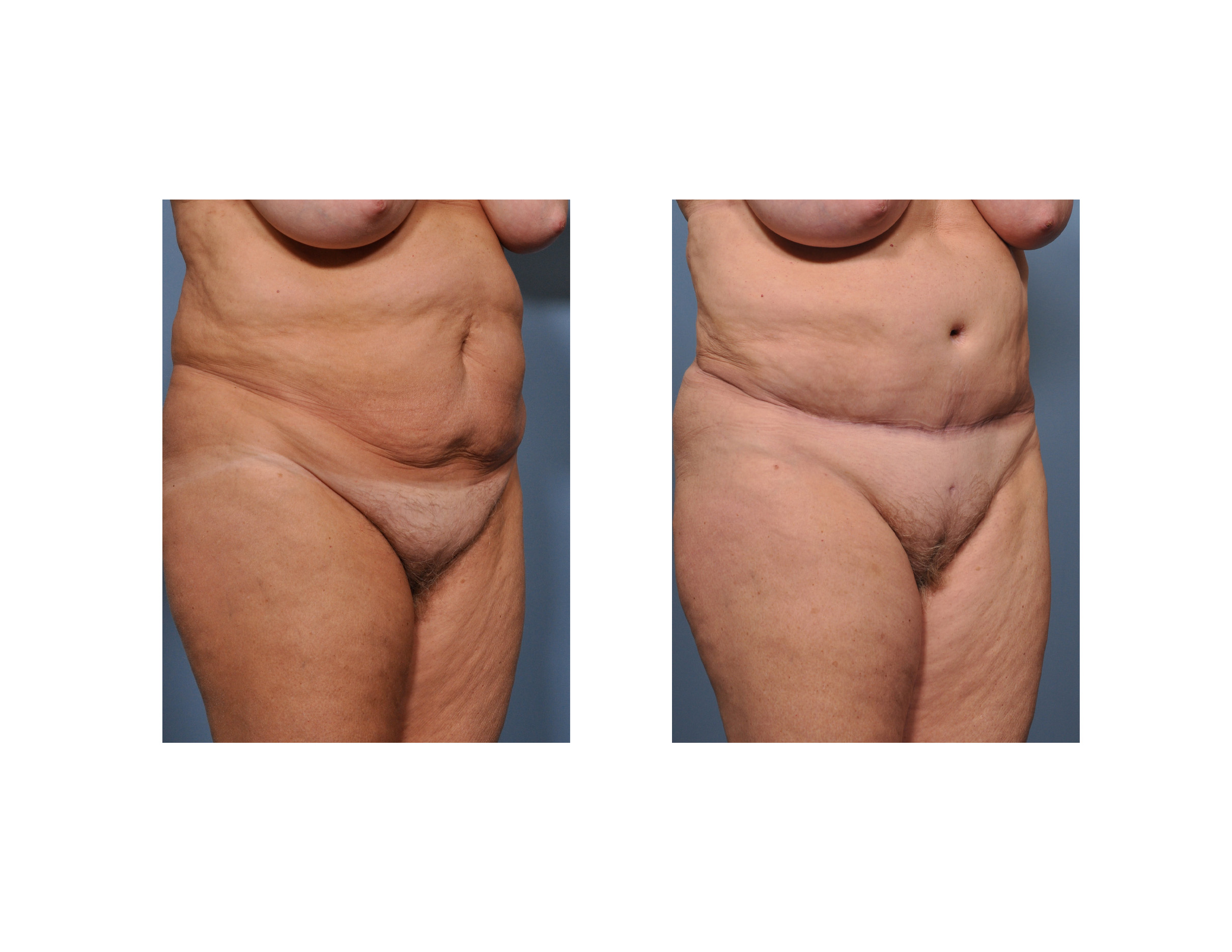 Case Study: Tummy Tuck with Pubic Liposuction - Explore Plastic Surgery