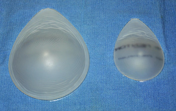 Volume Sizing Sytem - An Improved Method of Implant Size Selection in Breast  Augmentation - Explore Plastic Surgery