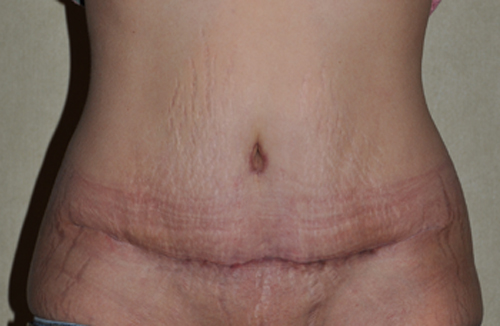 What Happens To My Belly Button During a Tummy Tuck? - Brown