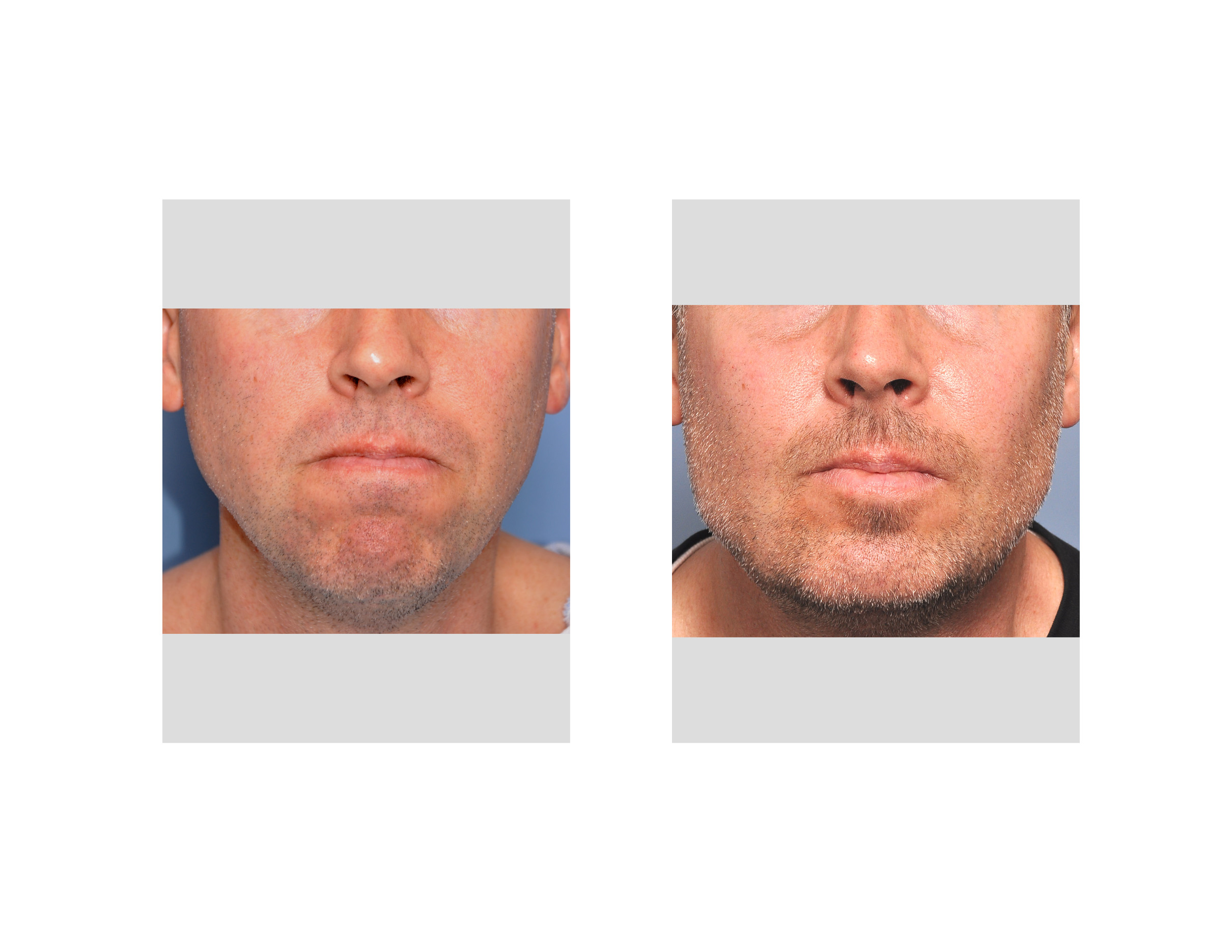 Case Study Jaw Angle Implants In Jawline Enhancement Explore Plastic