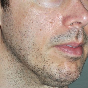 Options in Aesthetic Jawline Enhancement - Explore Plastic Surgery