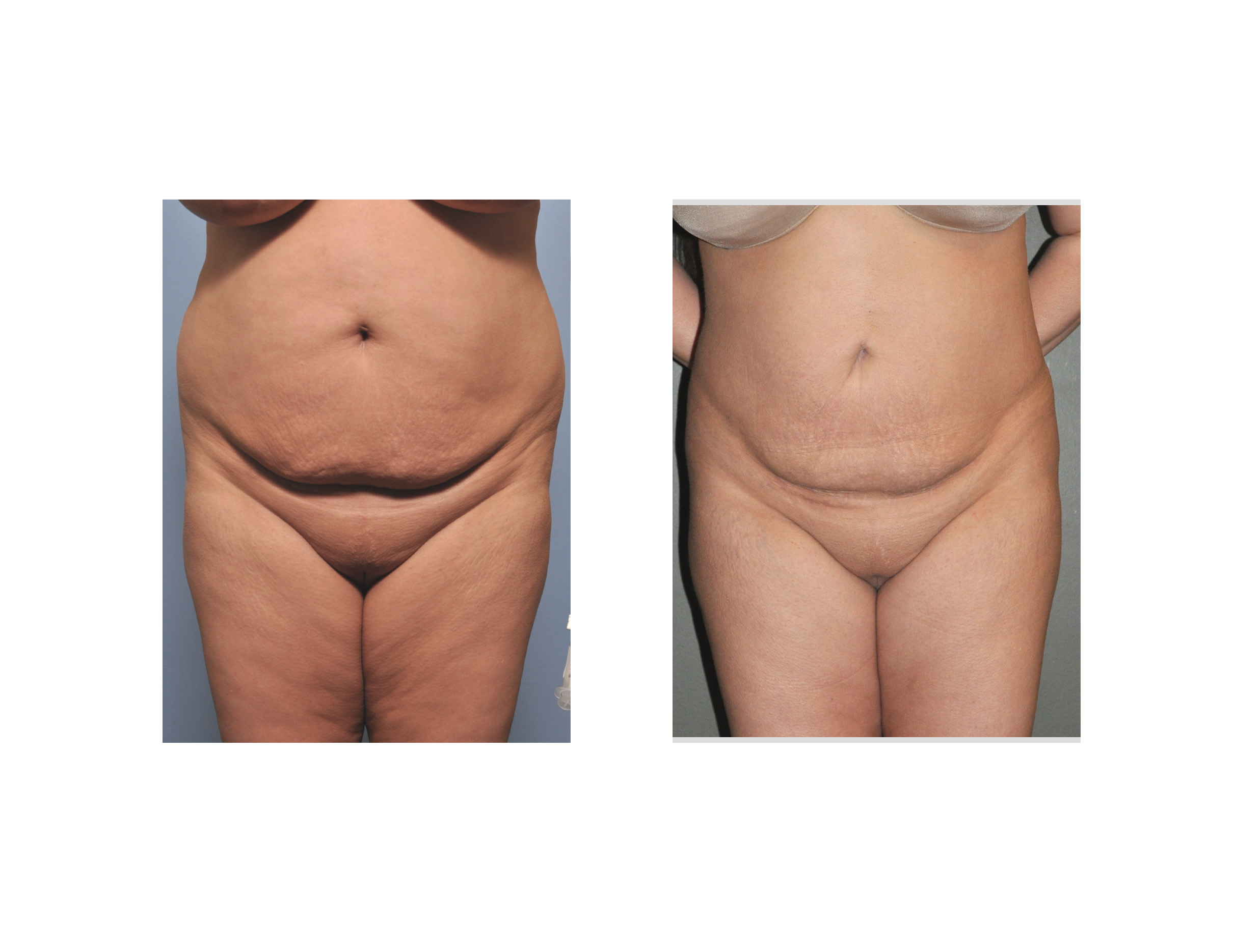 Flank, Back, and Waist Liposuction