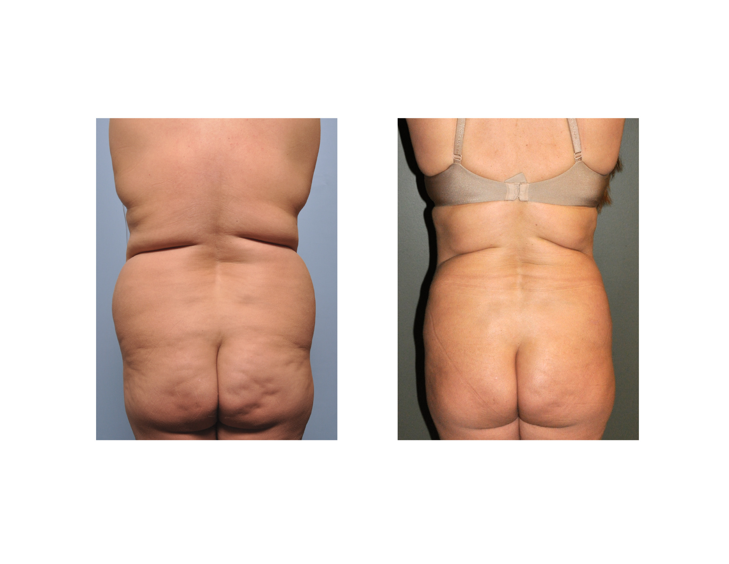 Flank, Back, and Waist Liposuction, flanks 