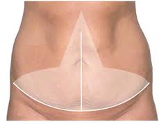 The Fleur-de-lis Tummy Tuck in the Extreme Weight Loss Patient - Explore Plastic  Surgery