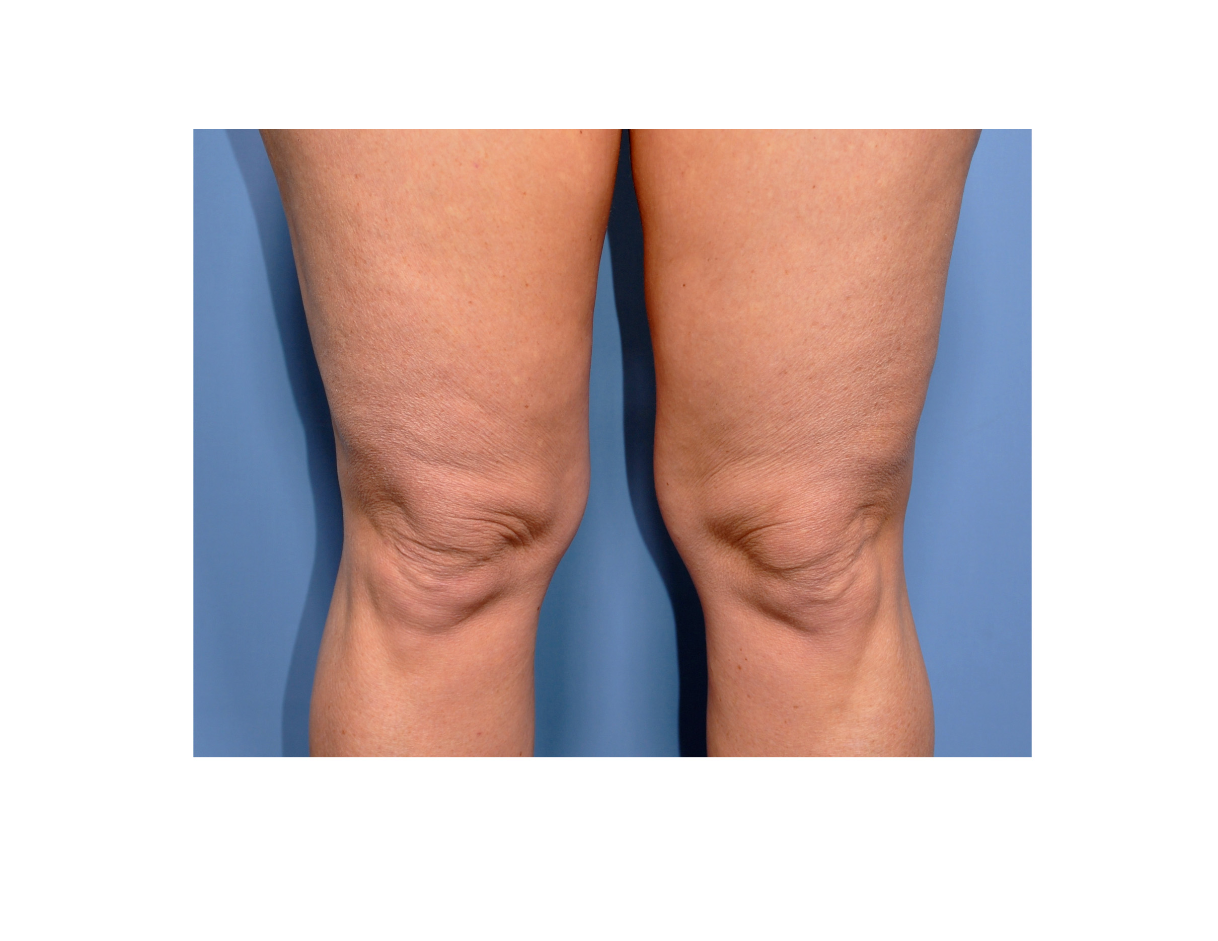 Fat Knees Dr Barry Eppley Indianapolis Explore Plastic Surgery