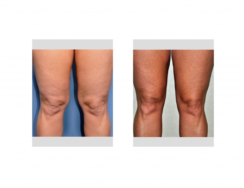 Knee Liposuction Result Dr Barry Eppley Indianapolis Explore Plastic Surgery 