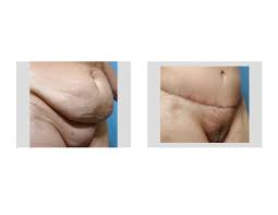 Successful Tummy Tuck and Monsplasty Combination in Weight Loss Patients -  Explore Plastic Surgery