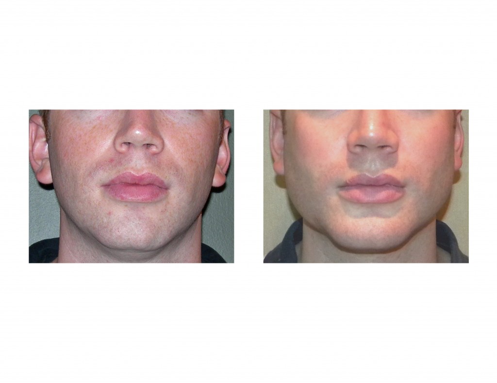 Contemporary Implant Concepts For Surgical Jawline Enhancement
