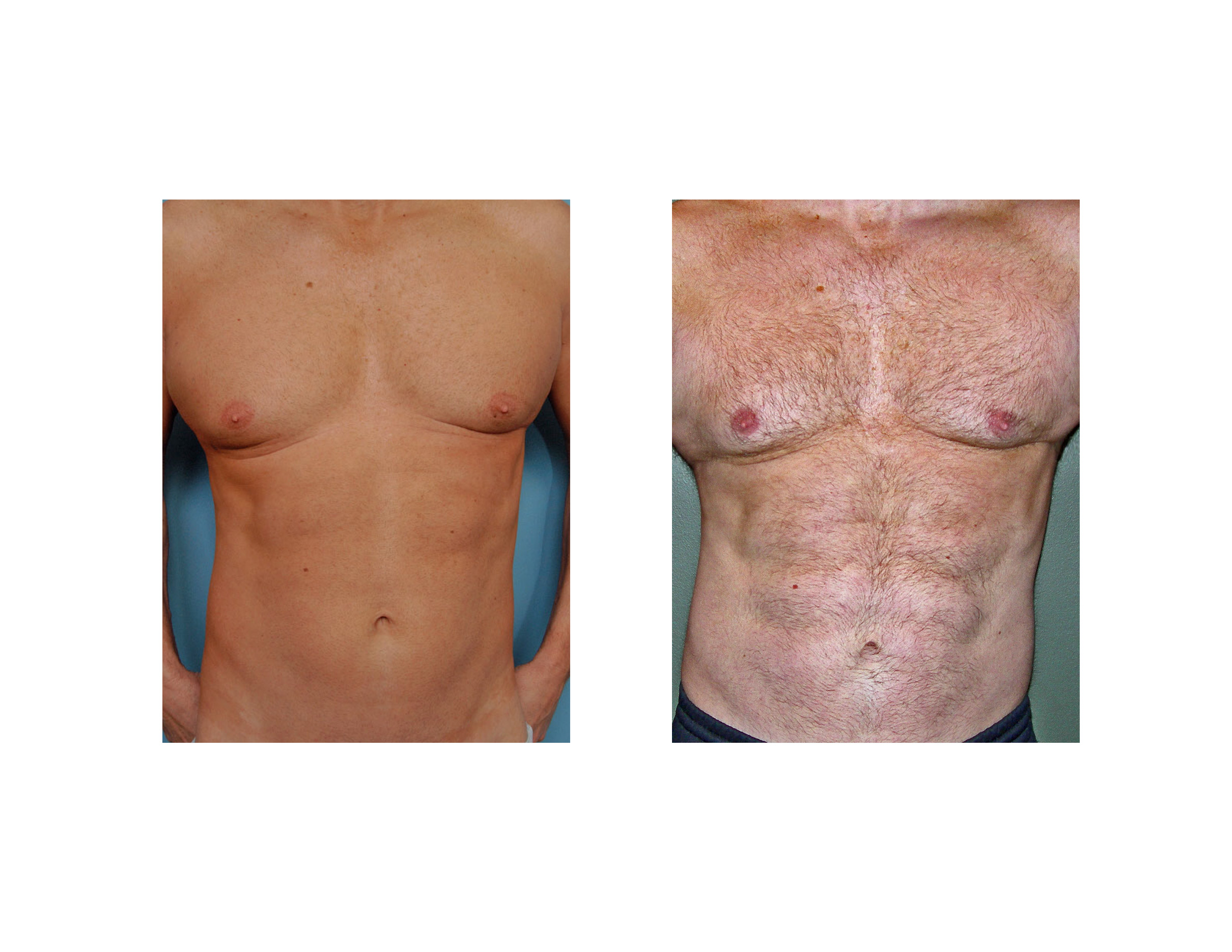 Case Study: Linear Liposuction for the Abdominal Six-Pack Look