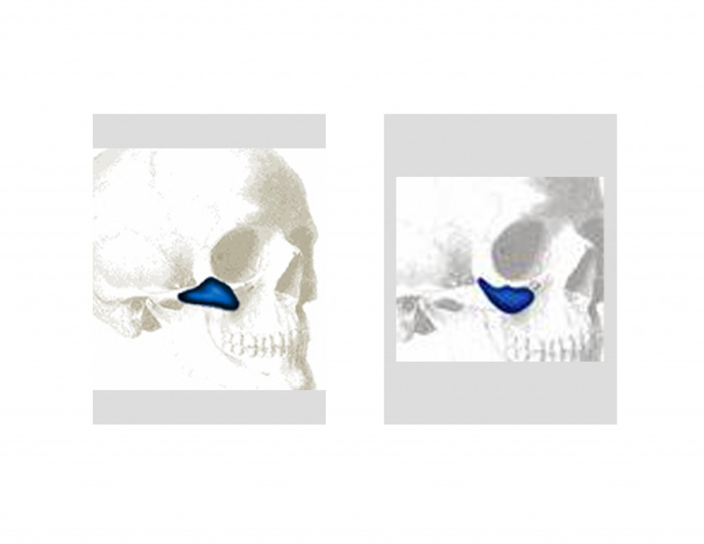 Understanding Cheek Implant Augmentation - Explore Plastic Surgery