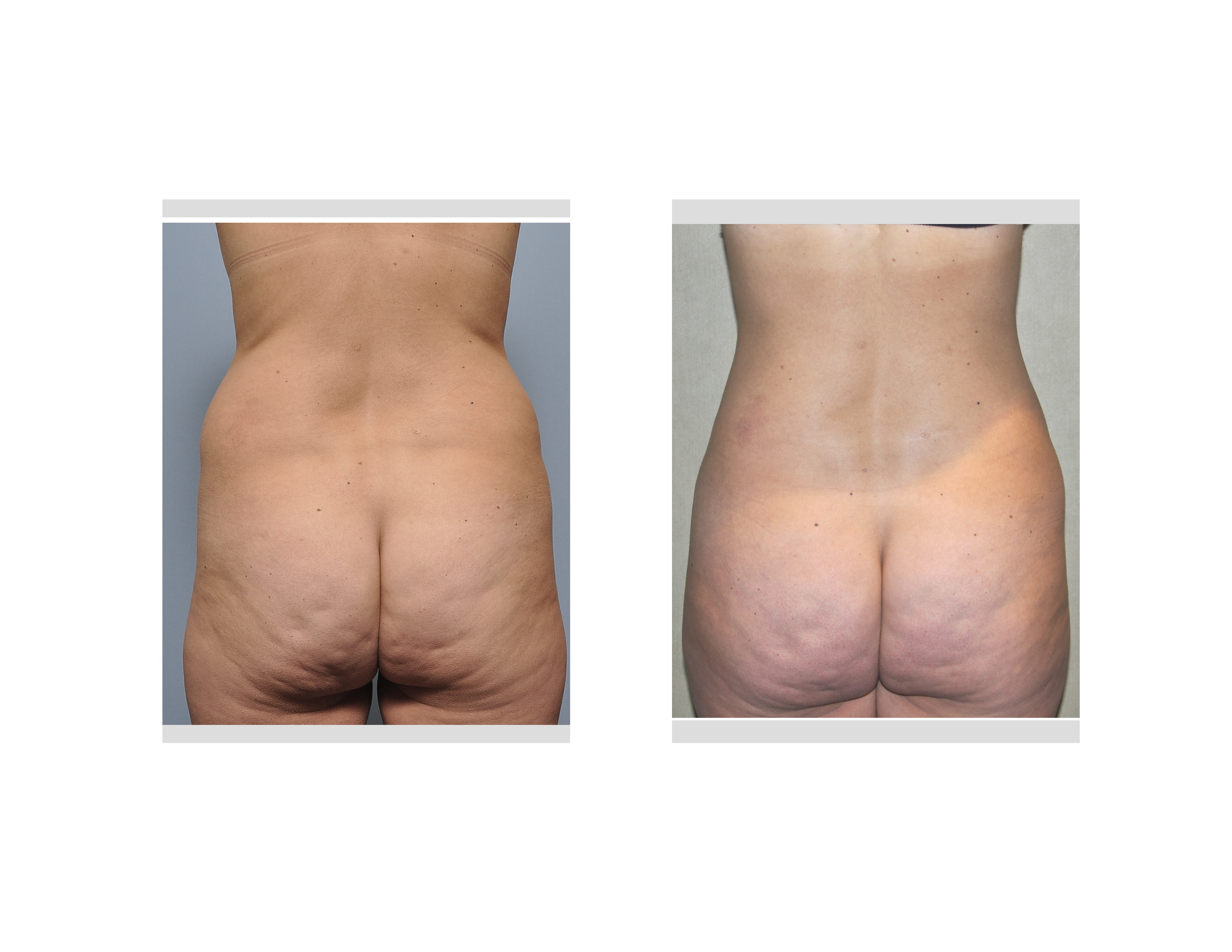Recovery and Results after Abdominal and Flank Liposuction