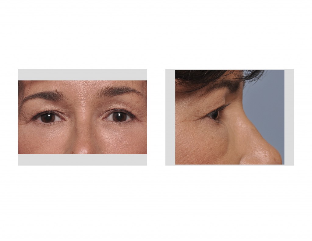 Case Study Upper Blepharoplasty (Eyelid Lifts) Under Local Anesthesia