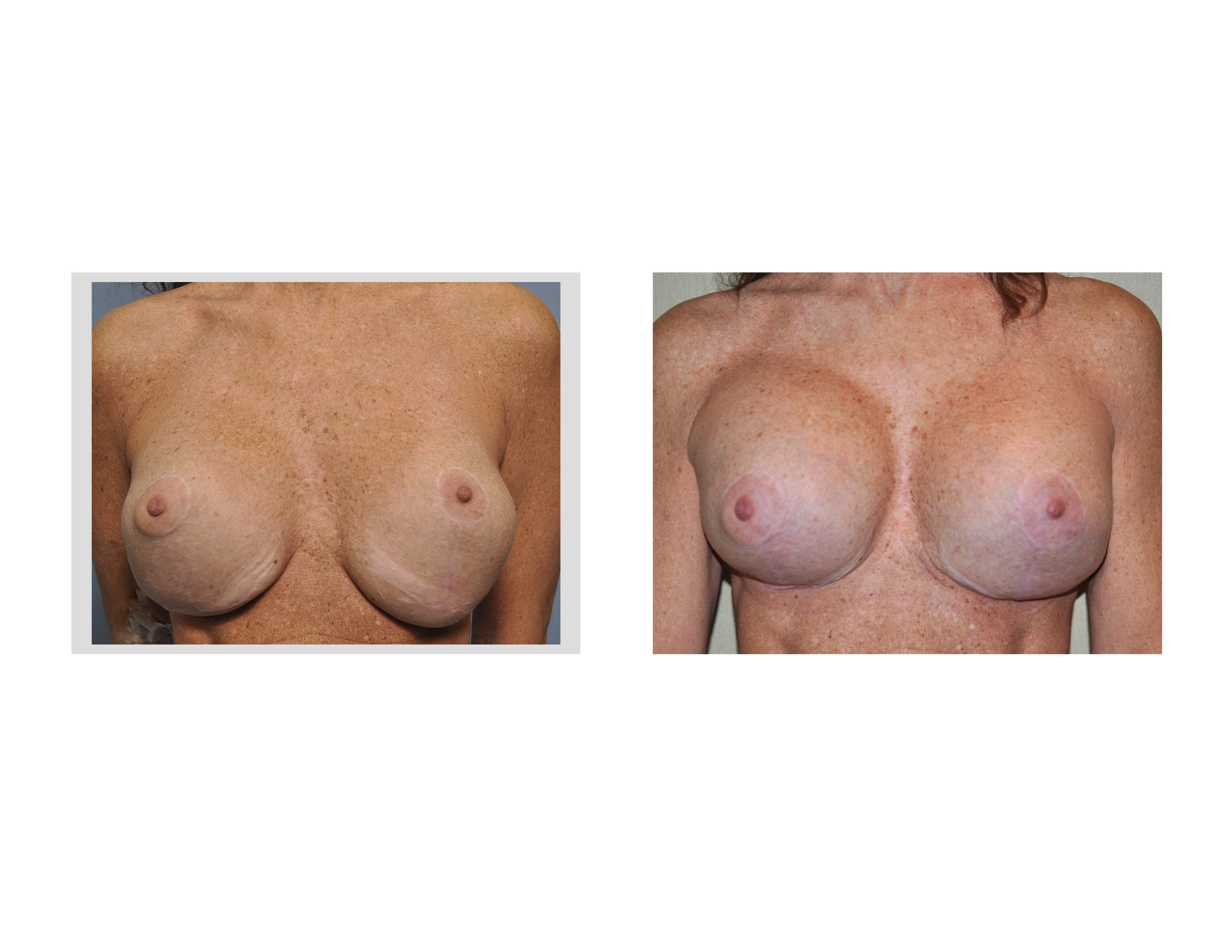 Stevo breast implants