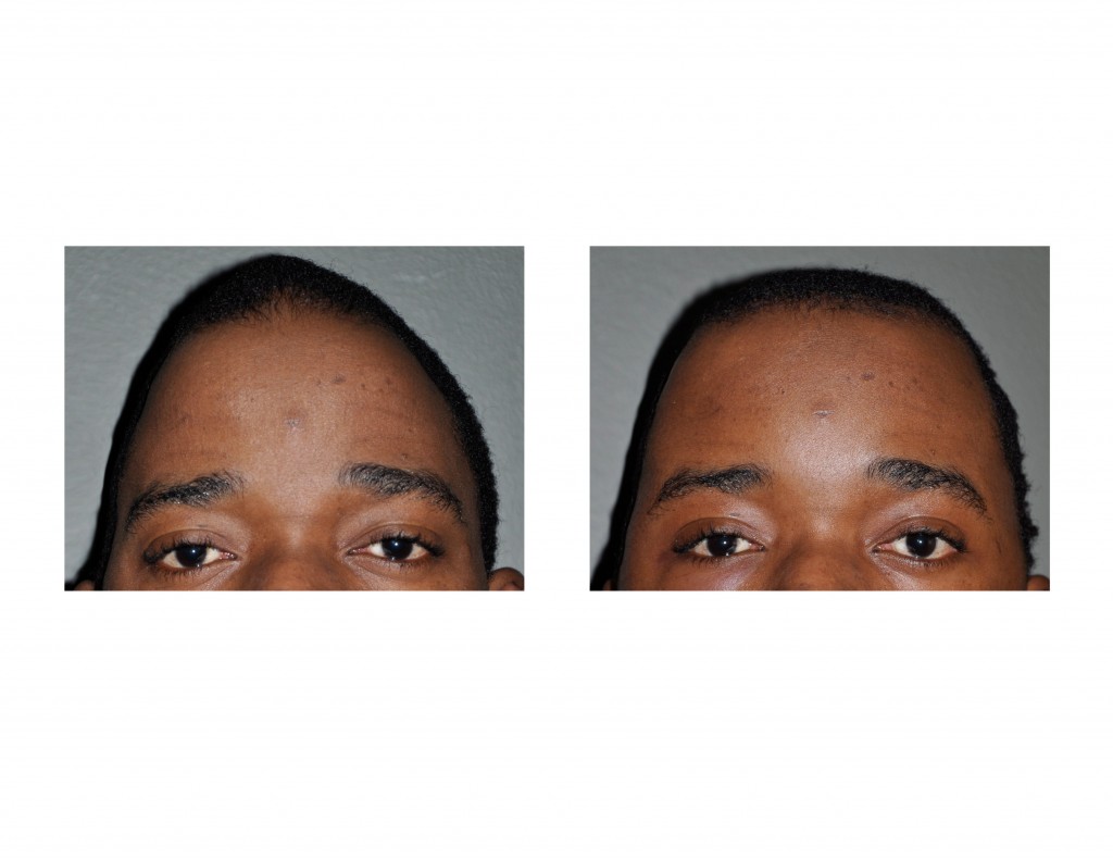 Case Study Skull Reshaping of the TriangularShaped Skull Deformity