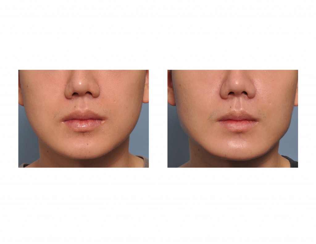 Case Study: Jaw Angle Implants For Complete Jawline Enhancement ...