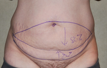 Tummy Tucks and the Pubic Lift Effect - Explore Plastic Surgery