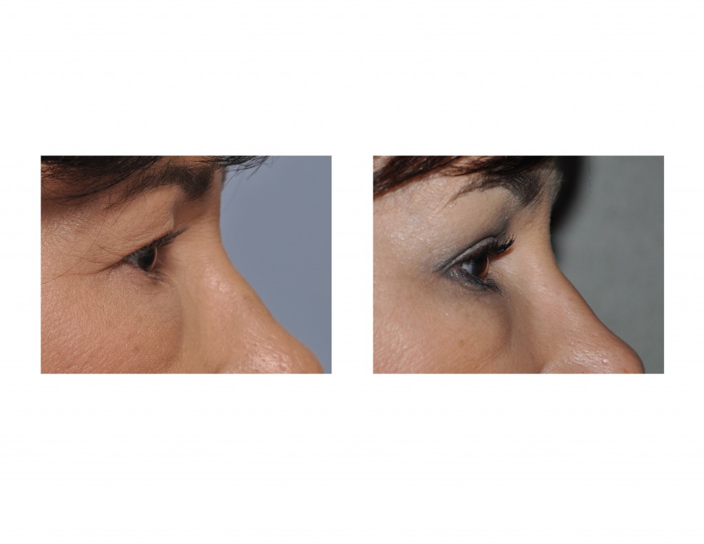 Case Study Upper Blepharoplasty (Eyelid Lifts) Under Local Anesthesia