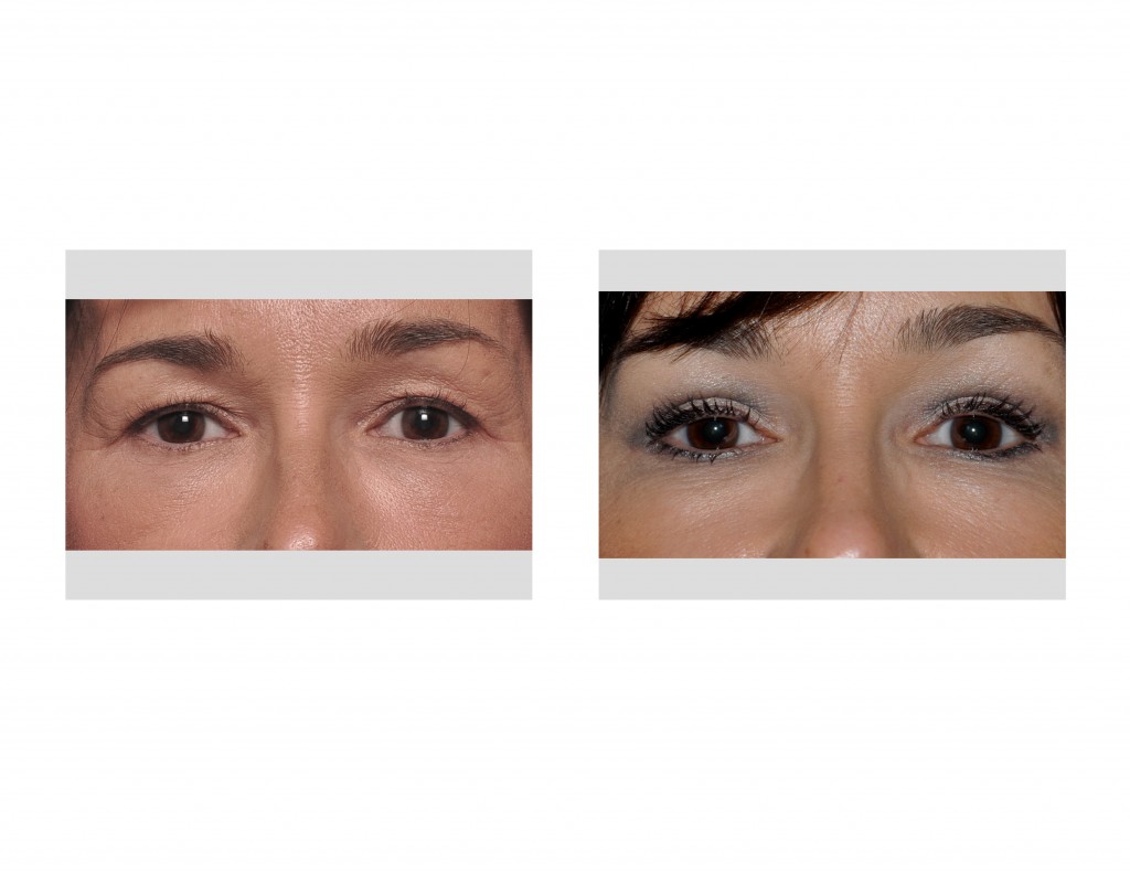 Case Study Upper Blepharoplasty (Eyelid Lifts) Under Local Anesthesia