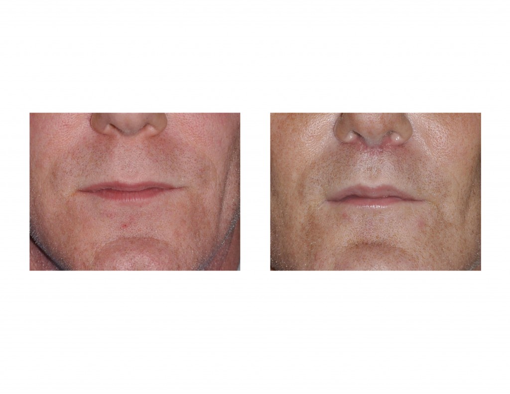 Case Study: The BullHorn Lip Lift in Men - Explore Plastic Surgery