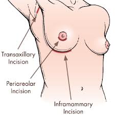 The Pros and Cons of the Transaxillary Breast Augmentation Incision