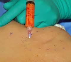 Fat Injections for the Treatment of the Double Bubble Deformity in Breast  Augmentation - Explore Plastic Surgery