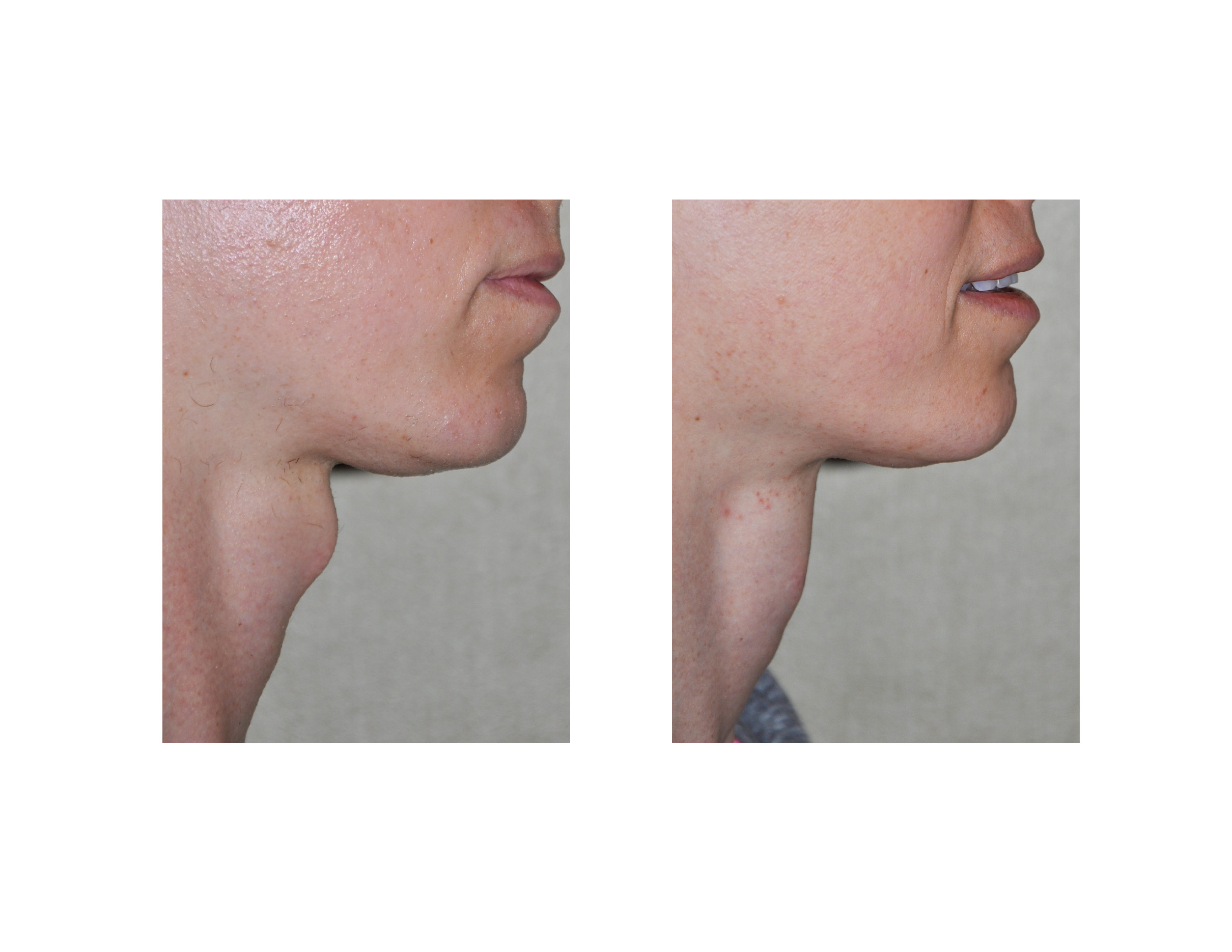 Case Study Tracheal Shave for Neck Feminization Explore